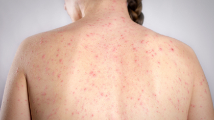 rash on woman's back