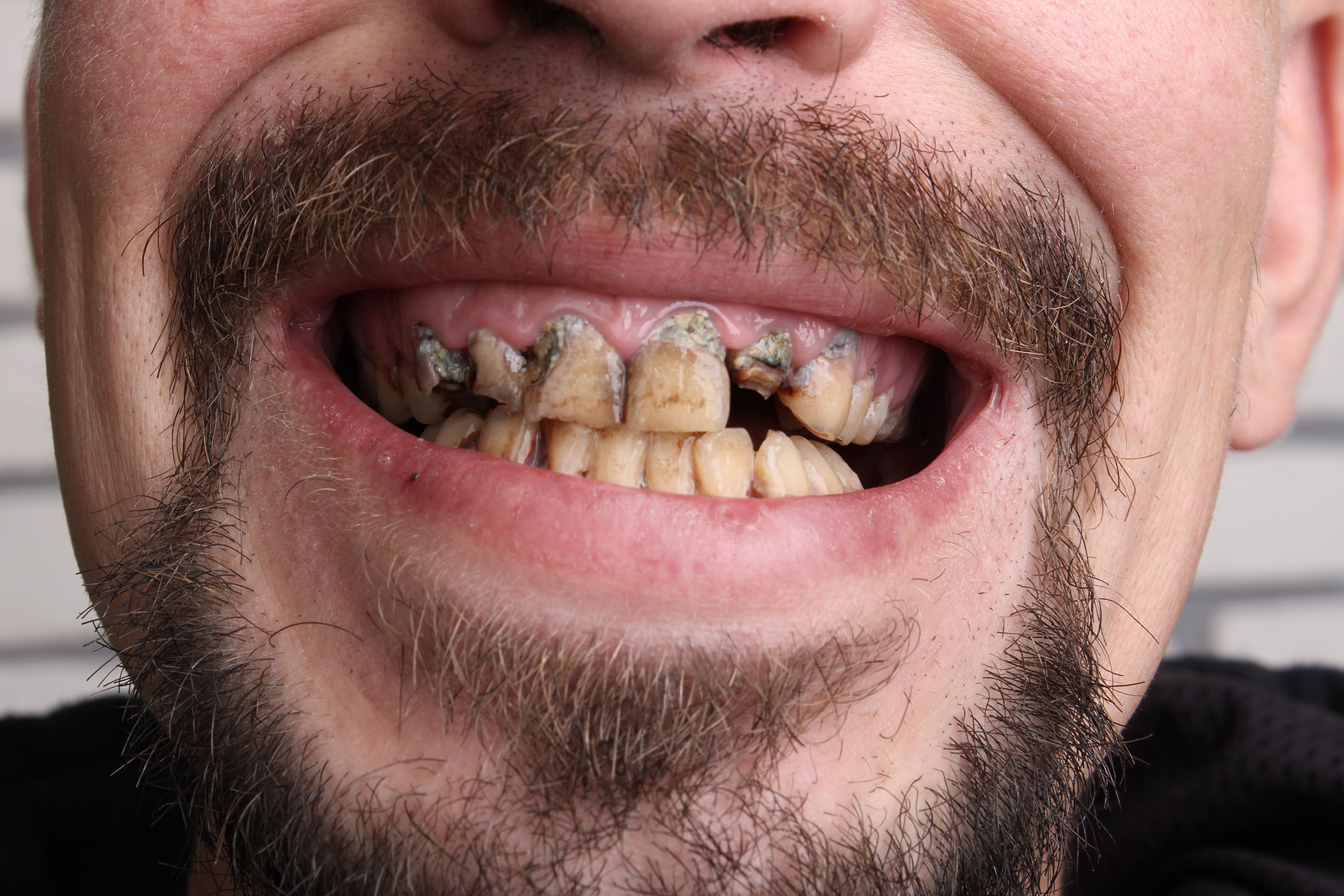 Tracking Firearm Violence and Impact on Dental Health Tracking Firearm Violence and Impact on Dental Health