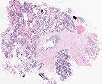 Prostate1sm