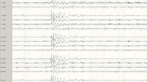 A representative EEG of a patient with generalized Epilepsy.