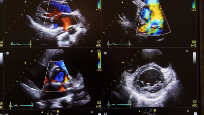 ultrasound of heart