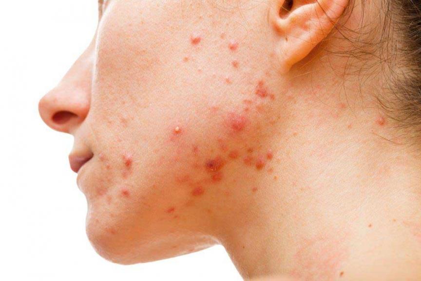 Image of woman with acne