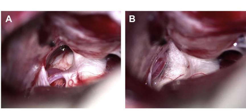 microvascular decompression