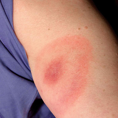 Lyme disease rash