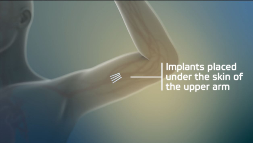 Implants